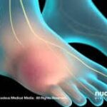 Complex Regional Pain Syndrome and Workers Compensation