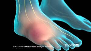 Complex Regional Pain Syndrome and Workers Compensation